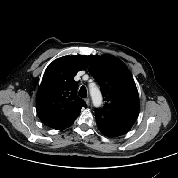 File:Bronchogenic carcinoma with L1 vertebra metastasis (Radiopaedia 9096-9805 Axial C+ delayed 7).jpg
