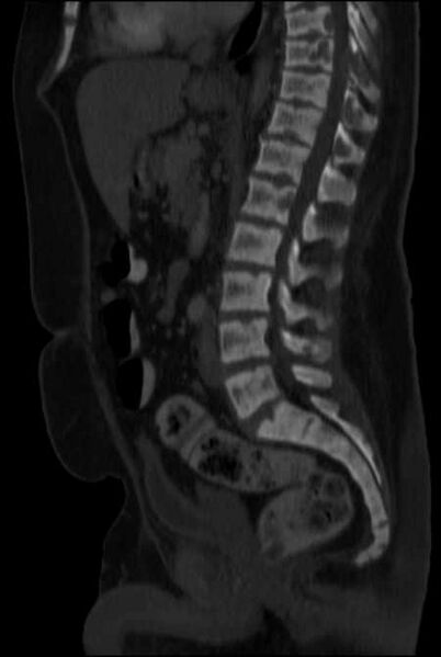 File:Brown tumors compressing the spinal cord (Radiopaedia 68442-77988 H 29).jpg