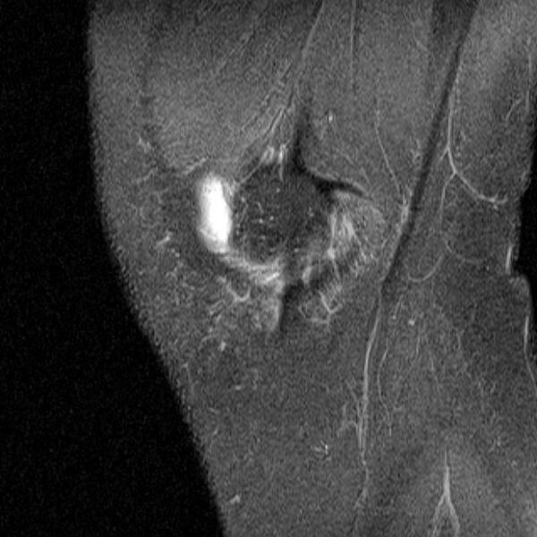 File:Bucket handle tear - medial meniscus (Radiopaedia 79028-91942 Sagittal PD fat sat 23).jpg