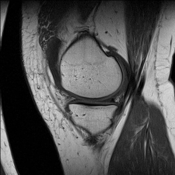 File:Bucket handle tear - medial meniscus (Radiopaedia 79028-91942 Sagittal T1 19).jpg