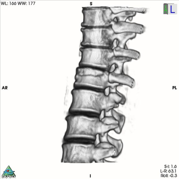 File:Bulging of paraspinal line in traumatic thoracal spinal compression fracture (Radiopaedia 29221-35872 3D VR 19).jpg
