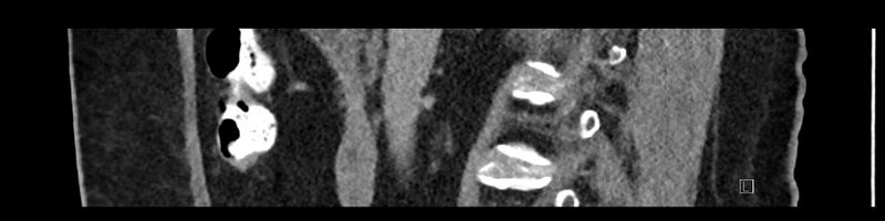 File:Buried bumper syndrome - gastrostomy tube (Radiopaedia 63843-72575 Sagittal Inject 74).jpg