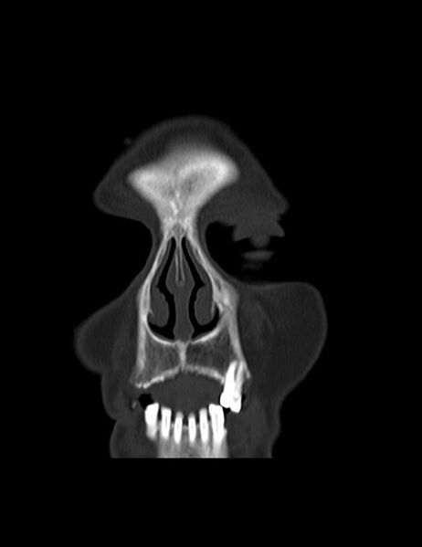 File:Burnt-out meningioma (Radiopaedia 51557-57337 Coronal bone window 1).jpg