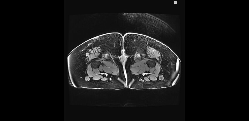 Buttock filler complications (Radiopaedia 63497-72115 Axial T1 C+ 59).jpg