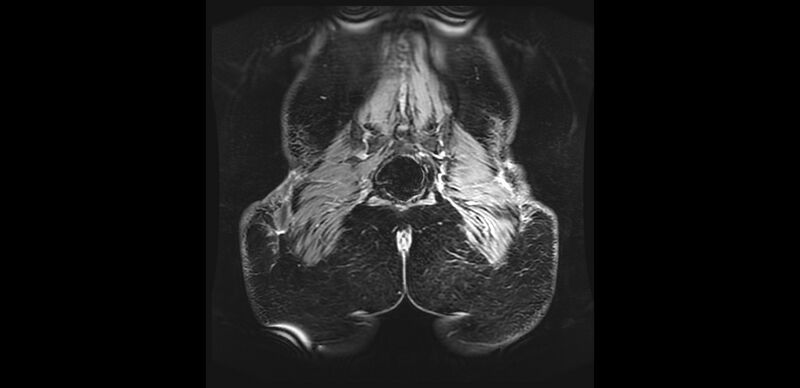 File:Buttock filler complications (Radiopaedia 63497-72115 Coronal T1 C+ 49).jpg