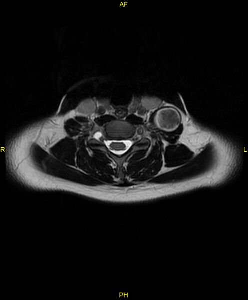 File:C5 nerve sheath tumor (Radiopaedia 85777-101596 Axial T2 50).jpg