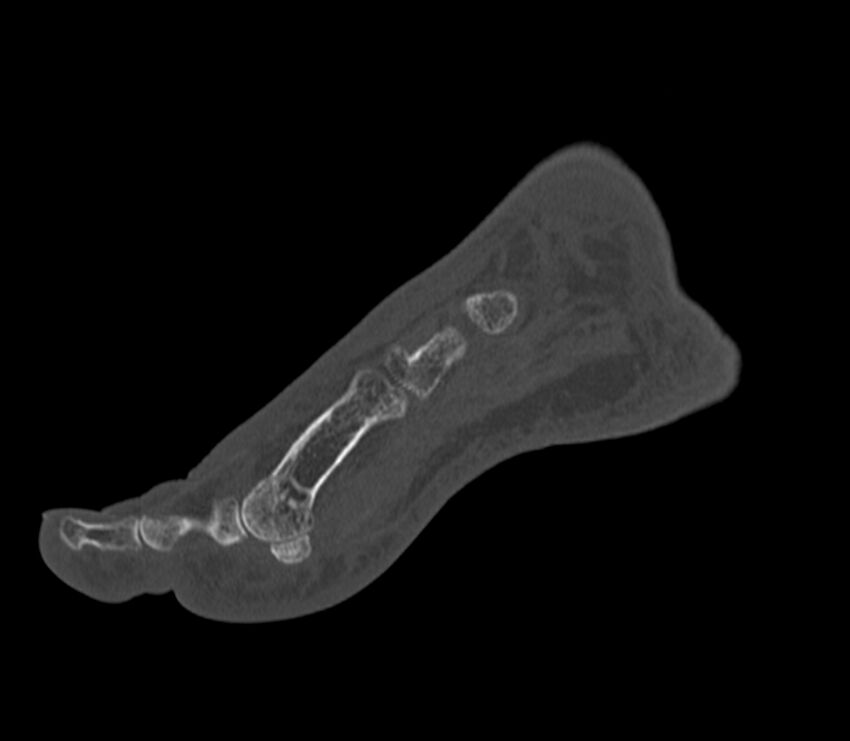 Calcaneal tuberosity avulsion fracture (Radiopaedia 22649-22668 Sagittal bone window 42).jpg