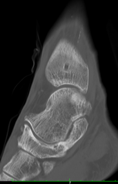 File:Calcaneonavicular coalition - bilateral osseous (Radiopaedia 11059-11464 Oblique bone window 1).png