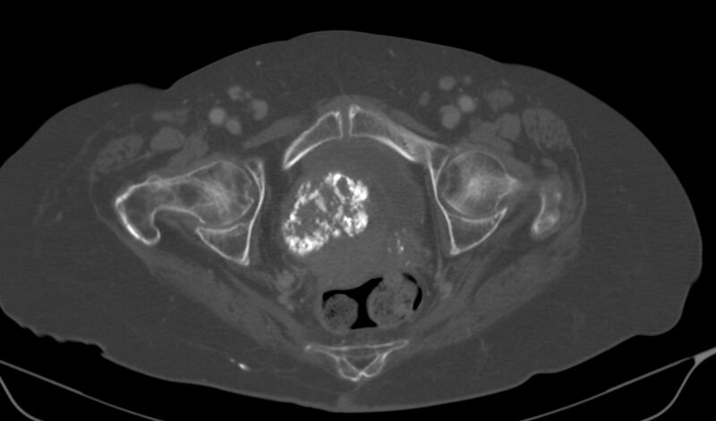 File:Calcified fibroids (Radiopaedia 20306-20228 Axial bone window 22).jpg