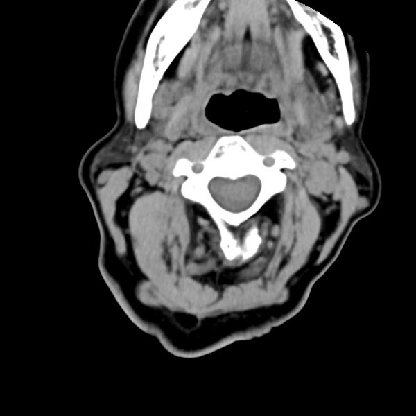 File:Calcified meningioma - cervical canal (Radiopaedia 70136-80171 B 13).jpg
