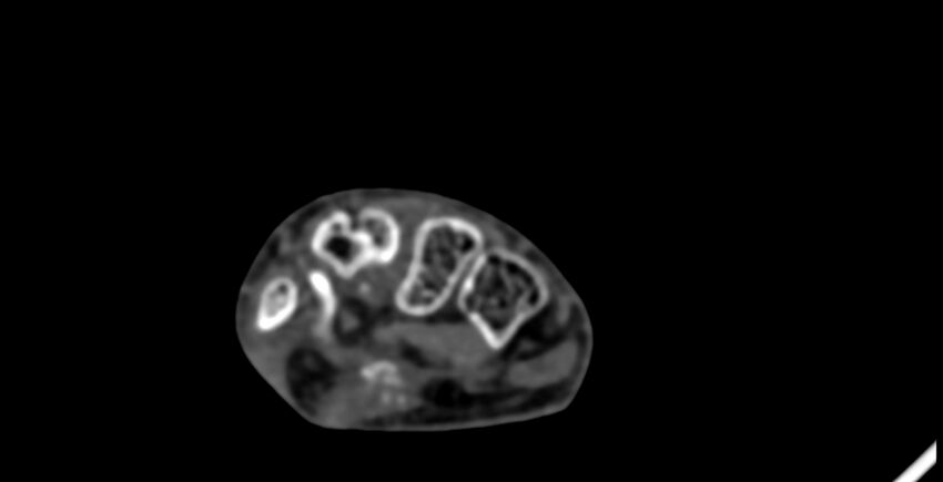 Calcifying aponeurotic fibroma (Radiopaedia 88423-105064 B 107).jpg