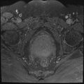 Cancer cervix - stage IIb (Radiopaedia 75411-86615 T1 fat sat 11).jpg