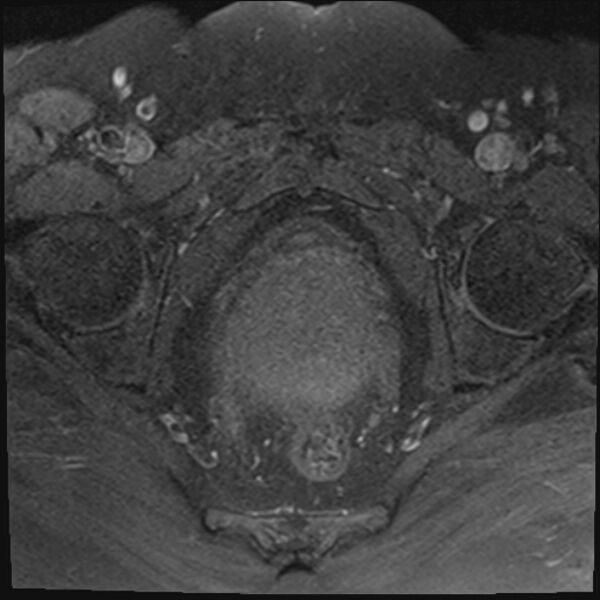 File:Cancer cervix - stage IIb (Radiopaedia 75411-86615 T1 fat sat 11).jpg