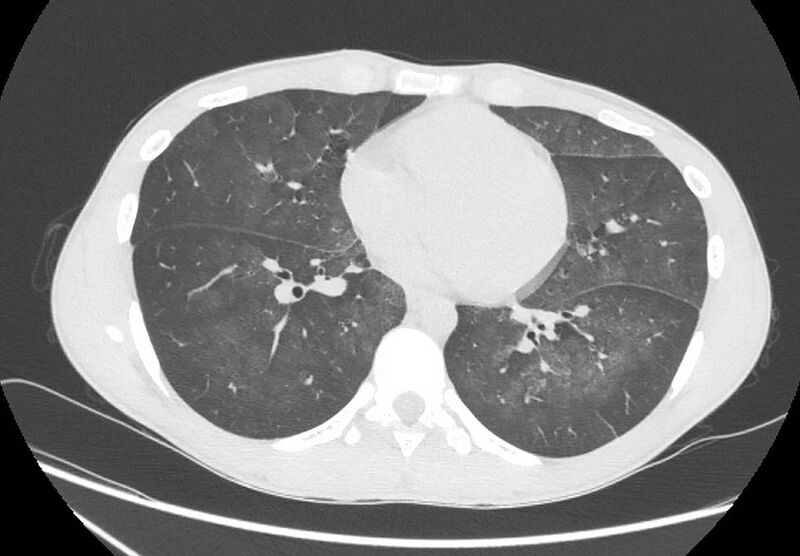 File:Cannabis-induced diffuse alveolar hemorrhage (Radiopaedia 89834-106946 Axial lung window 72).jpg