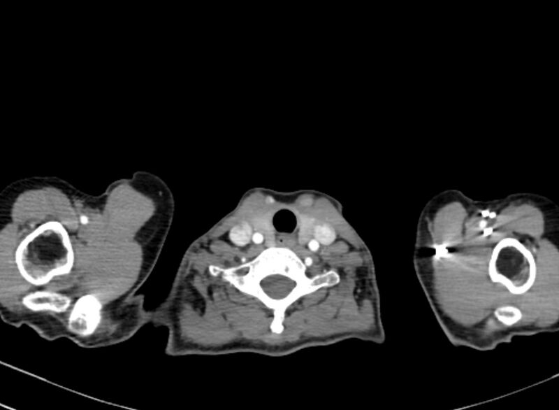File:Cannonball metastases from breast cancer (Radiopaedia 91024-108569 A 5).jpg