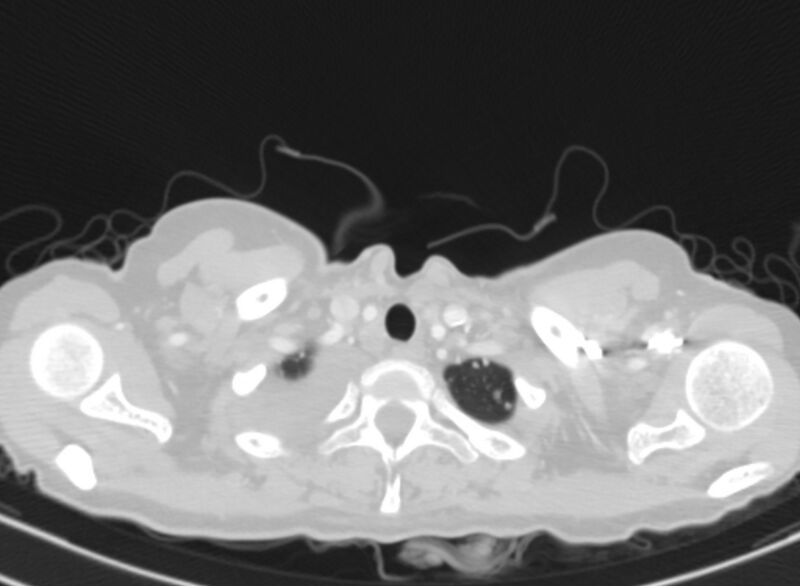 File:Cannonball metastases from breast cancer (Radiopaedia 91024-108569 Axial lung window 3).jpg
