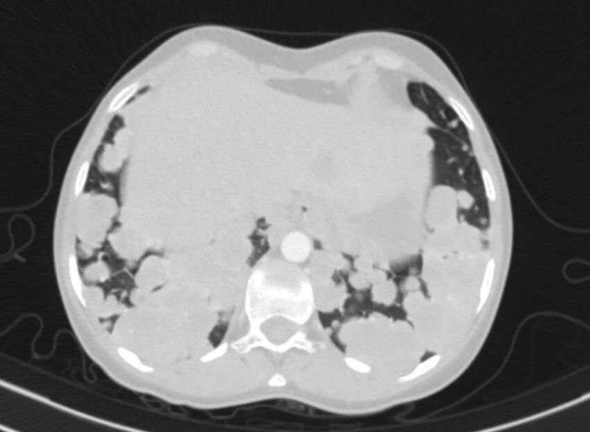 Cannonball metastases from breast cancer (Radiopaedia 91024-108569 Axial lung window 88).jpg