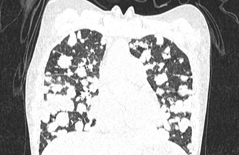 File:Cannonball metastases from breast cancer (Radiopaedia 91024-108569 Coronal lung window 56).jpg