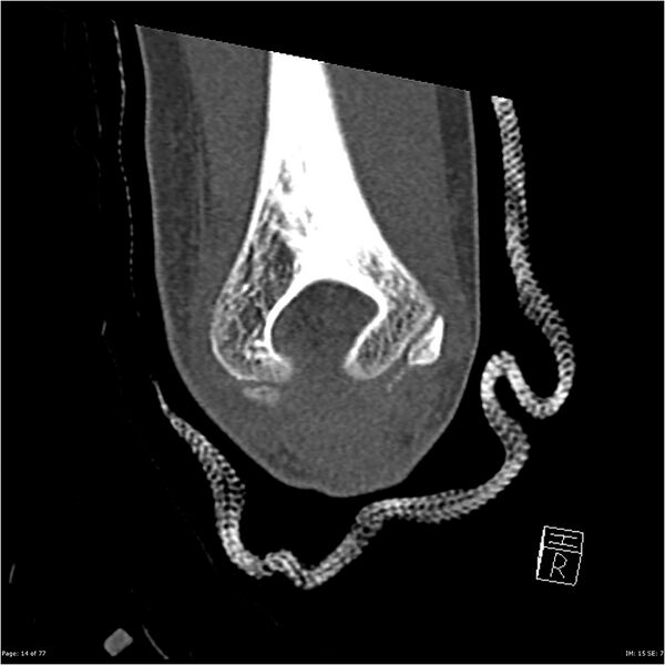 File:Capitellum fracture (Radiopaedia 23352-23426 Coronal bone window 14).jpg