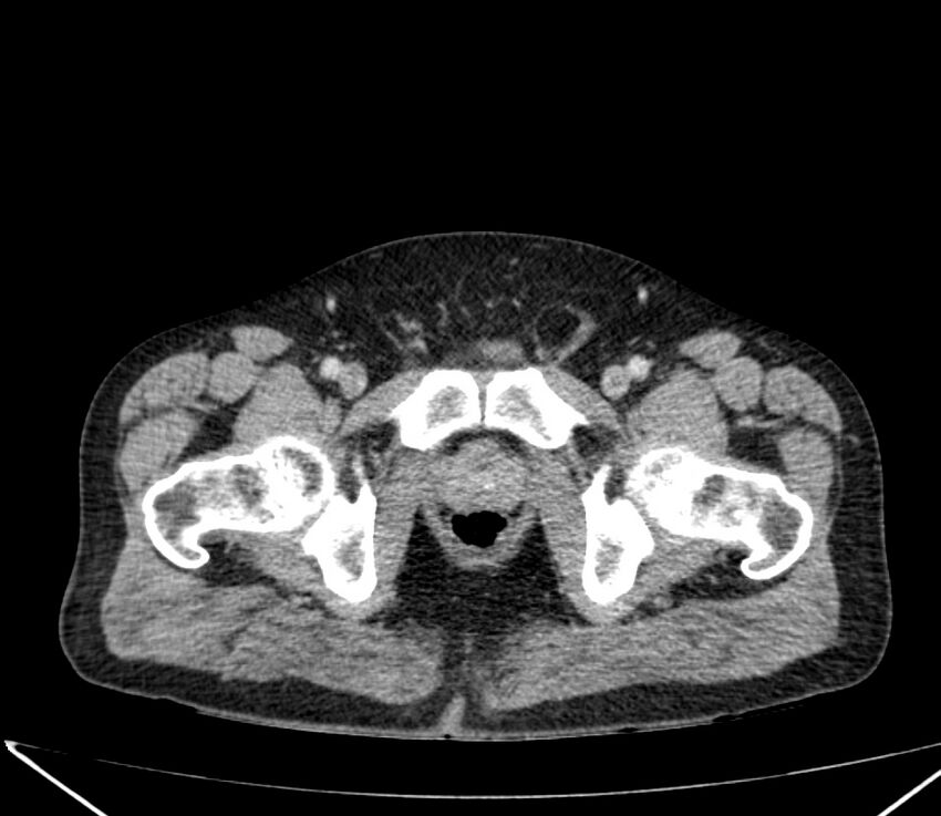 Carcinoid tumor with hepatic metastases (Radiopaedia 22651-22670 C 78).jpg