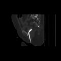 Carcinoma cervix- brachytherapy applicator (Radiopaedia 33135-34173 Sagittal bone window 111).jpg