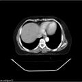 Carcinoma cervix- recurrence (Radiopaedia 34702-36137 B 6).jpg