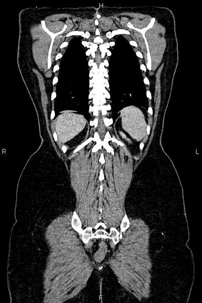 File:Carcinoma of uterine cervix (Radiopaedia 85861-101700 C 50).jpg