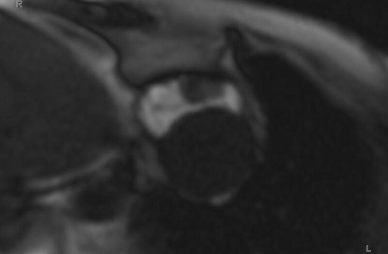 File:Cardiac hemangioma (Radiopaedia 31709-32631 Short axis 104).jpg