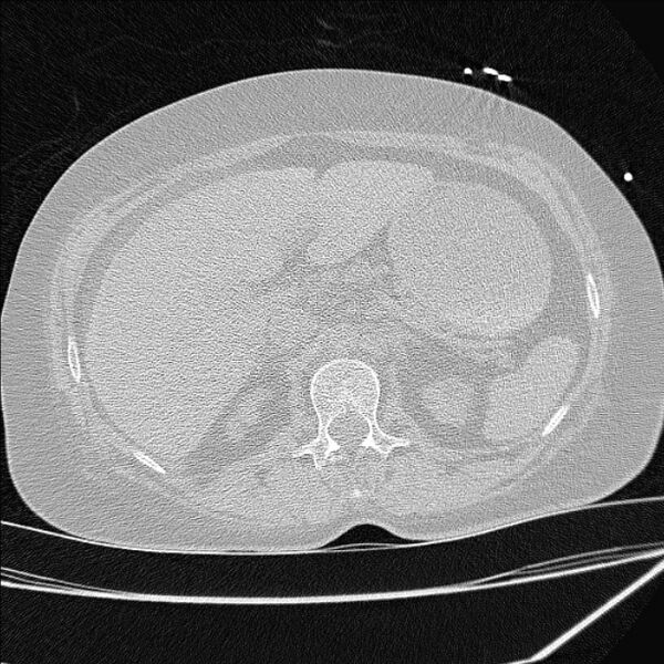 File:Cardiogenic pulmonary edema (Radiopaedia 29213-29609 Axial lung window 114).jpg