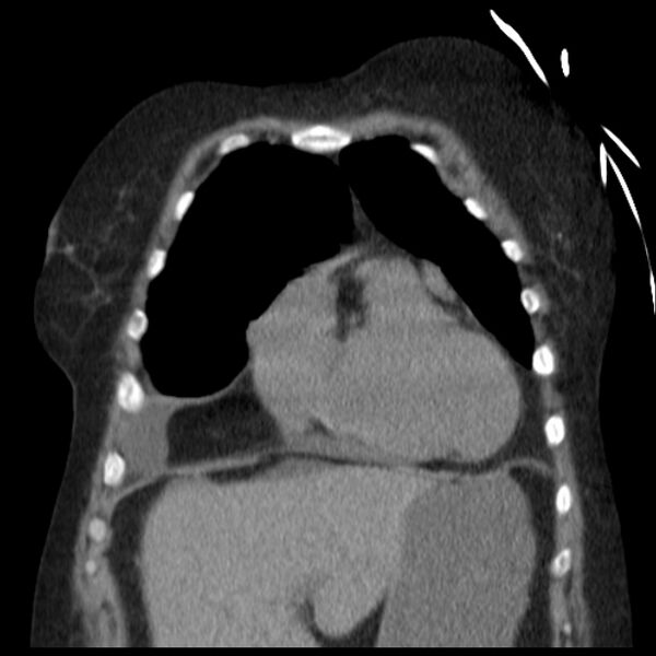 File:Cardiogenic pulmonary edema (Radiopaedia 29213-29609 Coronal non-contrast 9).jpg