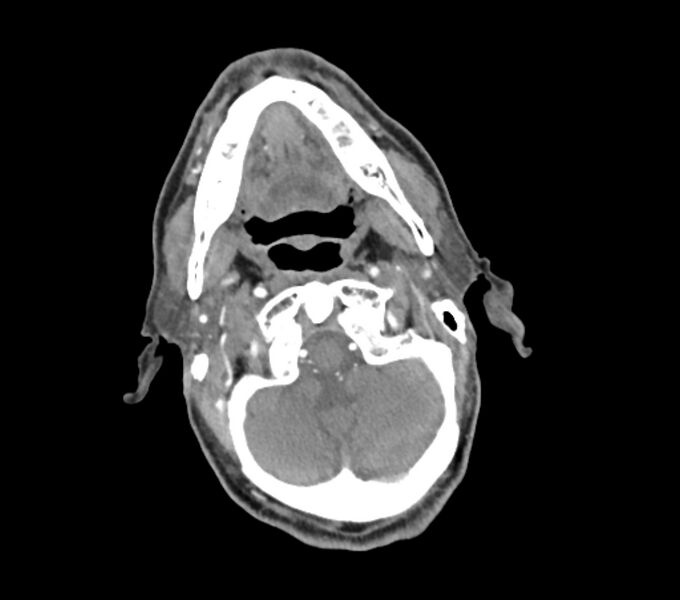 File:Carotid artery pseudoaneurysm (Radiopaedia 84030-99259 C 21).jpg