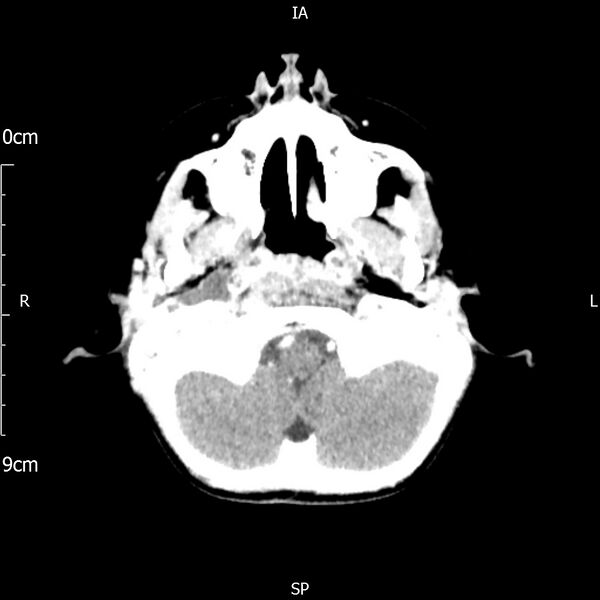 File:Cavernous sinus thrombosis (Radiopaedia 79414-92510 Axial Brain 51).jpg