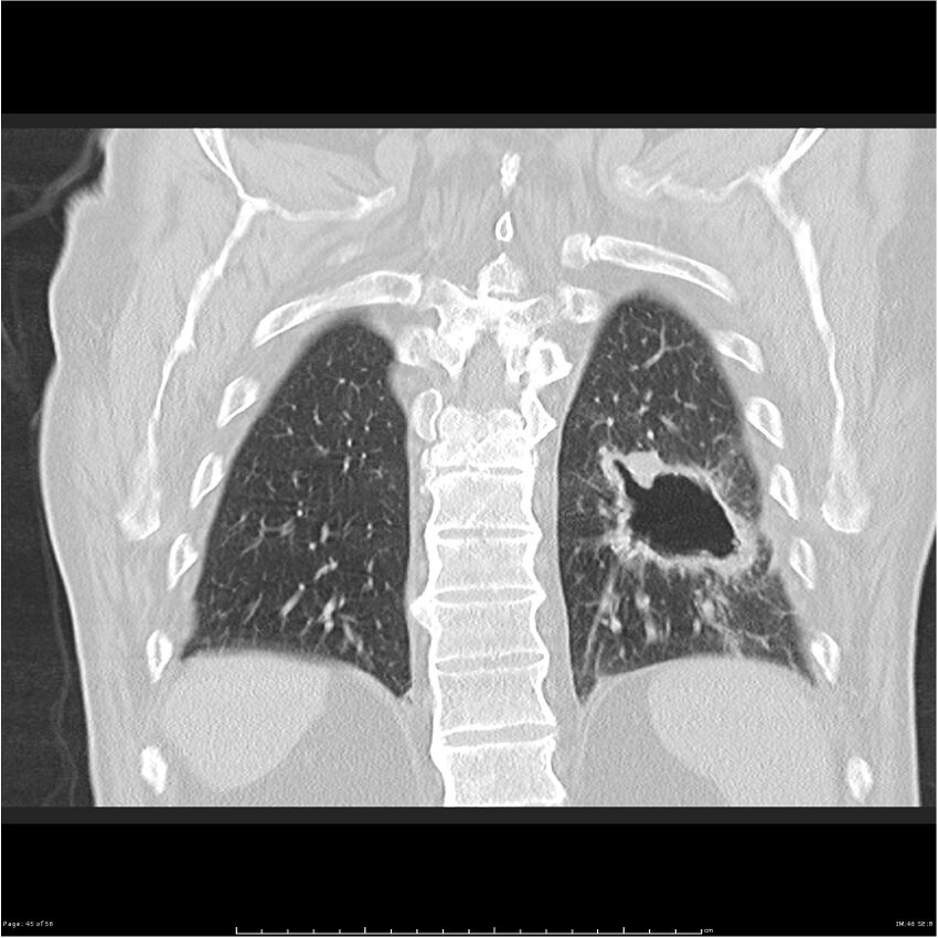 Cavitating left lower lobe lesion - squamous cell lung cancer (Radiopaedia 27749-28176 Coronal lung window 45).jpg