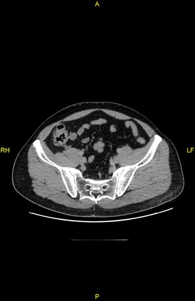 File:Cecal epiploic appendagitis (Radiopaedia 86047-102164 A 119).jpg