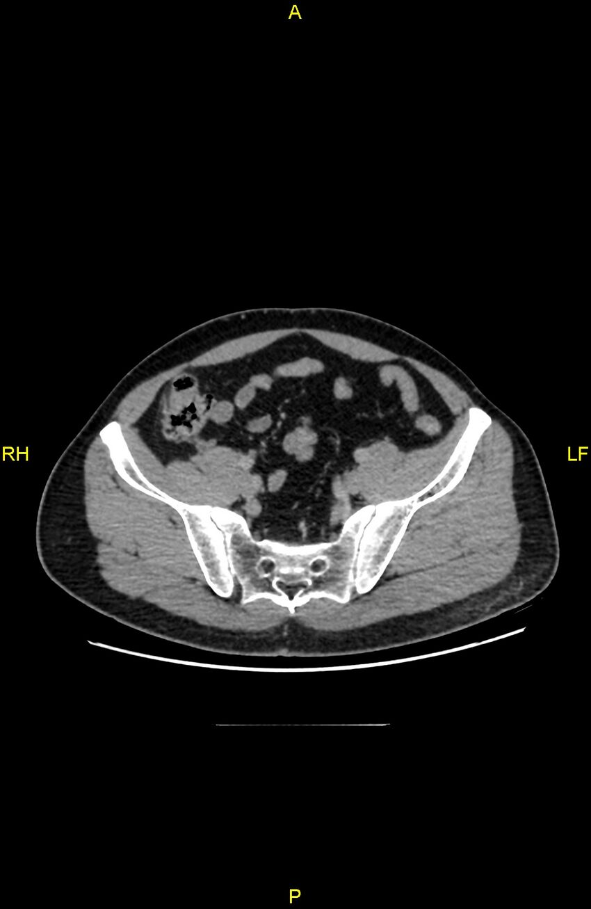 Cecal epiploic appendagitis (Radiopaedia 86047-102164 A 119).jpg