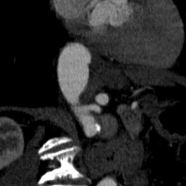 File:Celiac artery aneurysm (Radiopaedia 21574-21525 B 4).JPEG