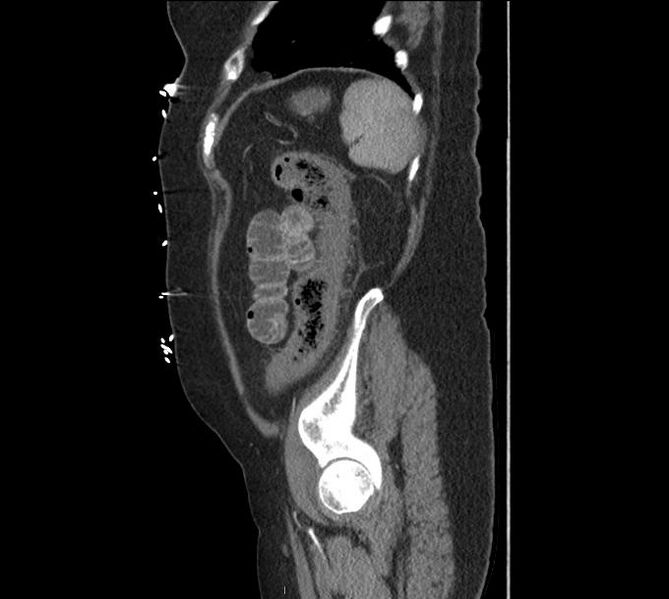 File:Celiac artery severe stenosis and dissection (Radiopaedia 44128-47842 A 7).jpg