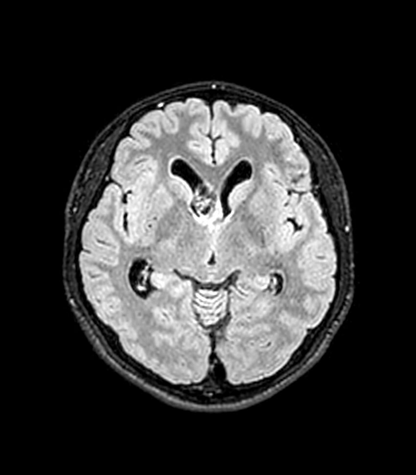 Central neurocytoma (Radiopaedia 79320-92380 Axial FLAIR 173).jpg