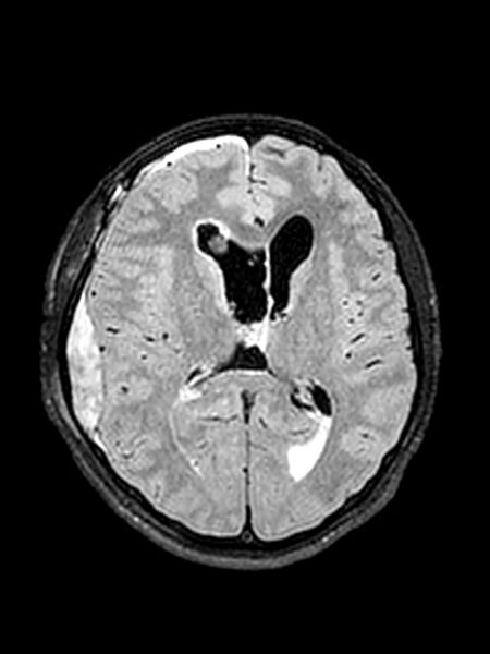 File:Central neurocytoma (Radiopaedia 79320-92381 Axial FLAIR 82).jpg