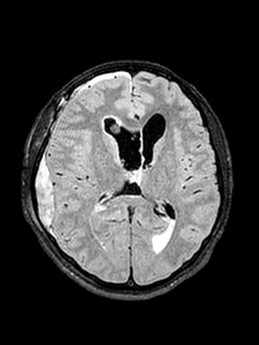Central neurocytoma (Radiopaedia 79320-92381 Axial FLAIR 82).jpg