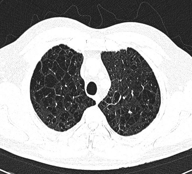File:Centrilobular pulmonary emphysema (Radiopaedia 26808-26971 Axial lung window 8).jpg