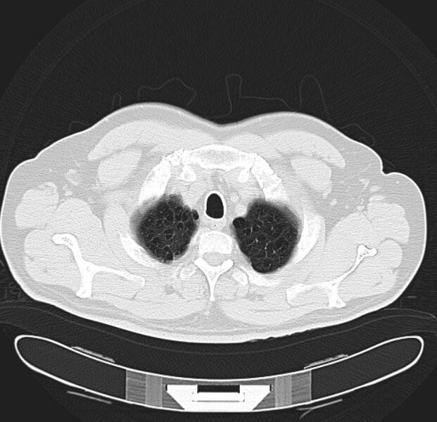 File:Centrilobular pulmonary emphysema (Radiopaedia 26808-26971 C 4).jpg