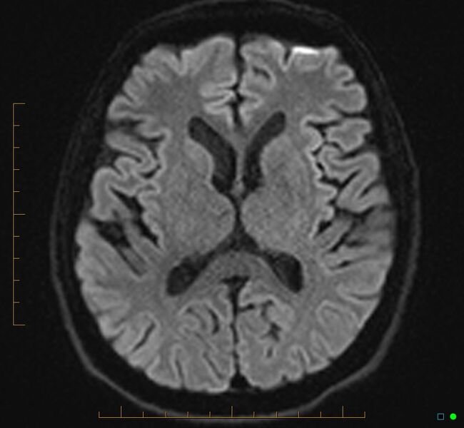 File:Cerebellar gangliocytoma (Radiopaedia 65377-74422 Axial DWI 21).jpg