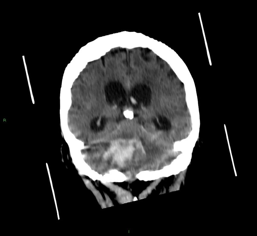 Cerebellar hemorrhage (Radiopaedia 58792-66026 Coronal non-contrast 27).jpg