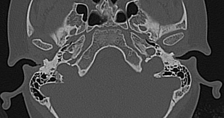 Cerebellopontine angle lipoma (Radiopaedia 57303-64242 Axial bone window 10).jpg
