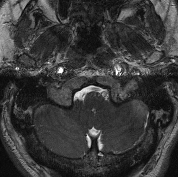 File:Cerebellopontine angle meningioma (Radiopaedia 24459-24764 I 5).jpg