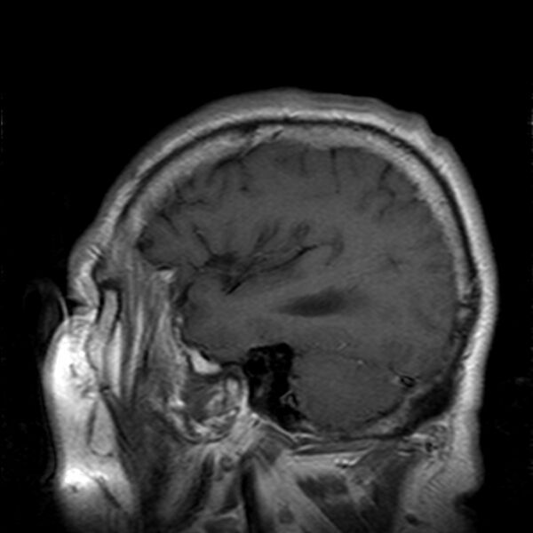 File:Cerebellopontine angle meningioma (Radiopaedia 24459-24764 Sagittal T1 C+ 21).jpg