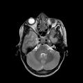 Cerebral abscess post cardiac surgery (Radiopaedia 27244-27420 Axial T2 6).jpg