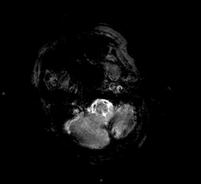 File:Cerebral amyloid angiopathy-associated lobar intracerebral hemorrhage (Radiopaedia 58377-65515 Axial Gradient Echo 22).jpg