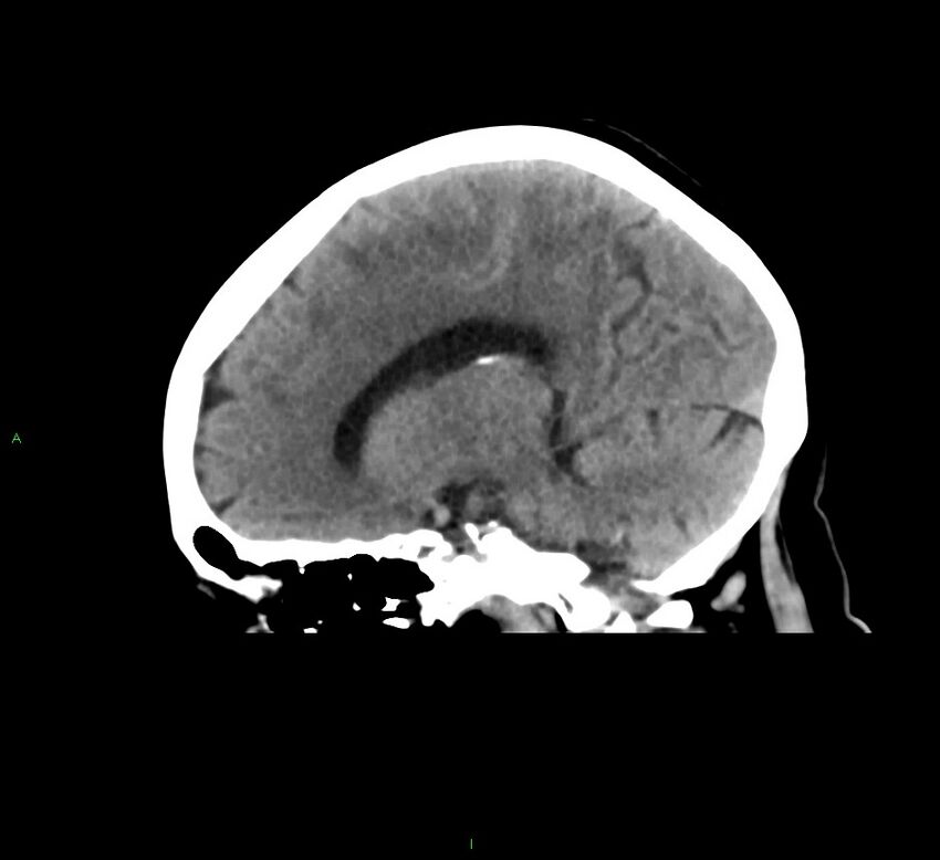 Cerebral amyloid angiopathy-associated lobar intracerebral hemorrhage (Radiopaedia 58378-65516 C 30).jpg